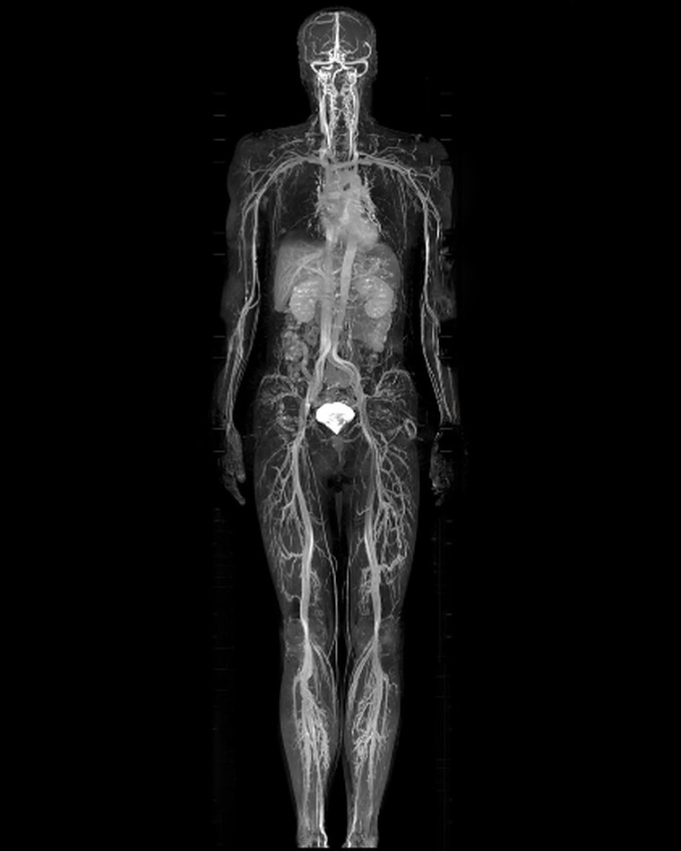 Whole-body angiography study