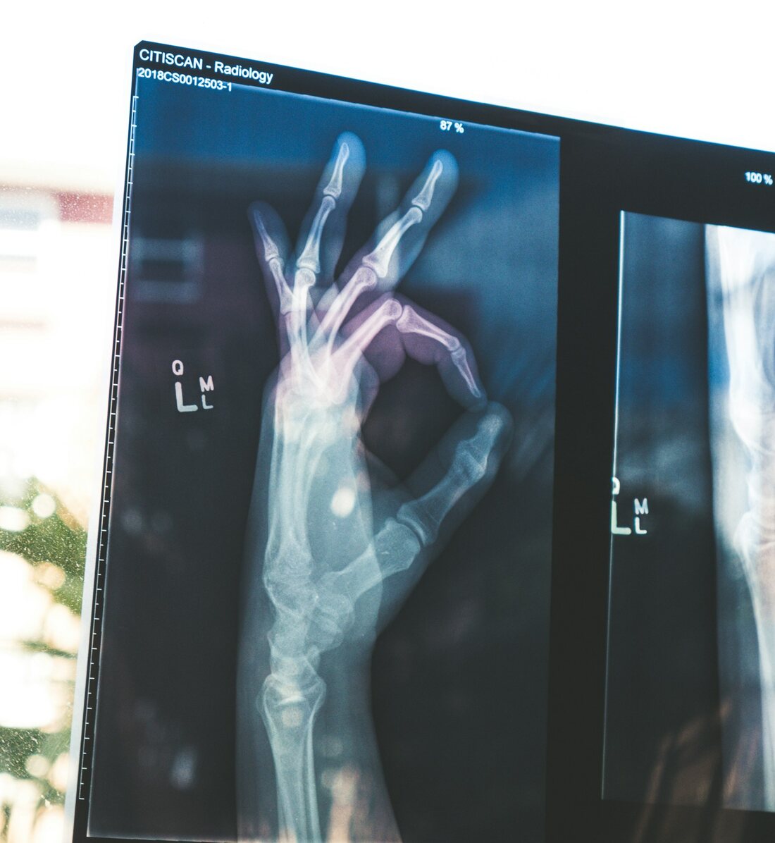 Backlit X-ray of a hand on a radiology display